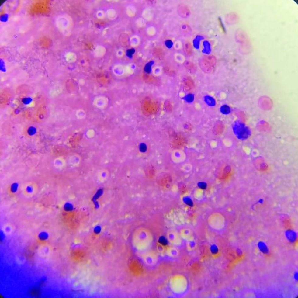 Fine needle aspiration cytology from cervical lymph showing refractile round structures (H&E, 400×)