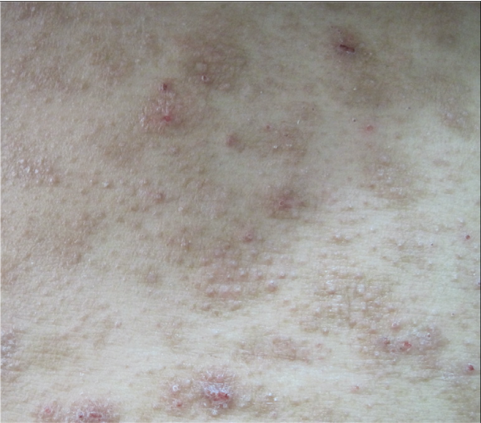 Follicular mycosis fungoides: Clinicohistopathologic features and ...