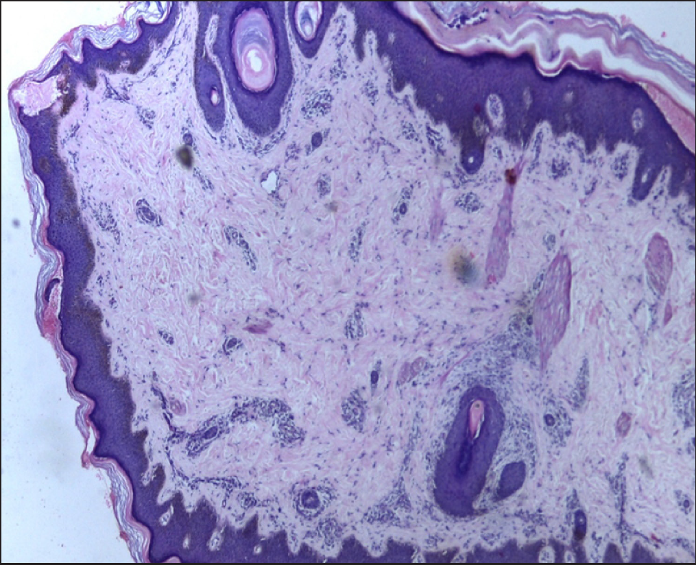 PLACK syndrome associated with alopecia areata and a novel homozygous ...