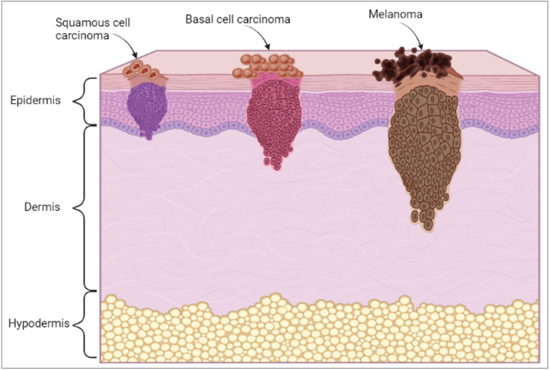 Deciphering the role of vitamin D on skin cancers and tumour ...