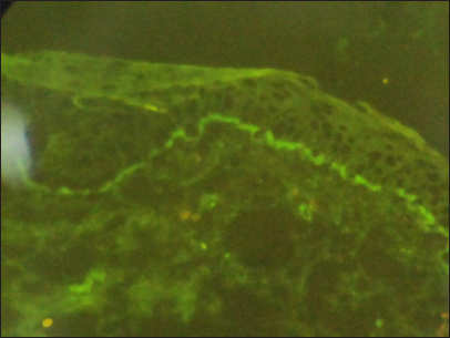 Bullous systemic lupus erythematosus in a pregnant woman with anaemia ...