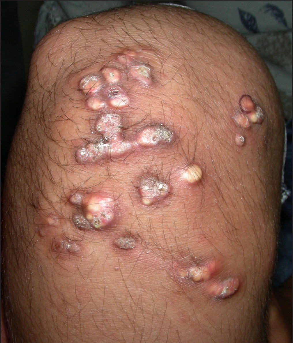 Multiple erythematous and yellow, discrete and coalescent, papules and nodules with central ulceration, white scaling and crusting on the right knee in a 13-year-old girl. Some papules are linearly arranged