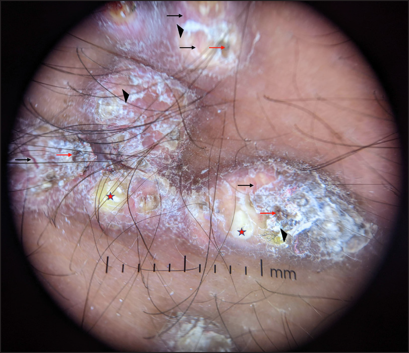 Dermatoscopy of erythematous ulcerated papules showing scaling (black triangles), crusting (red arrows), central yellow globules (red stars) surrounded by areas of erythema and peripheral telangiectasias (black arrows) (Heine delta 20T, x10, polarised mode)