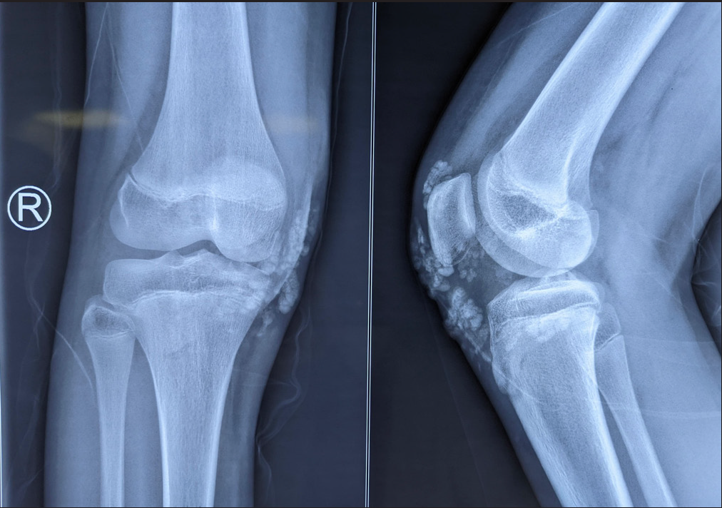 X-ray of right knee, antero-posterior and lateral view, showing amorphous opacities in the skin and subcutaneous plane suggestive of calcinosis cutis