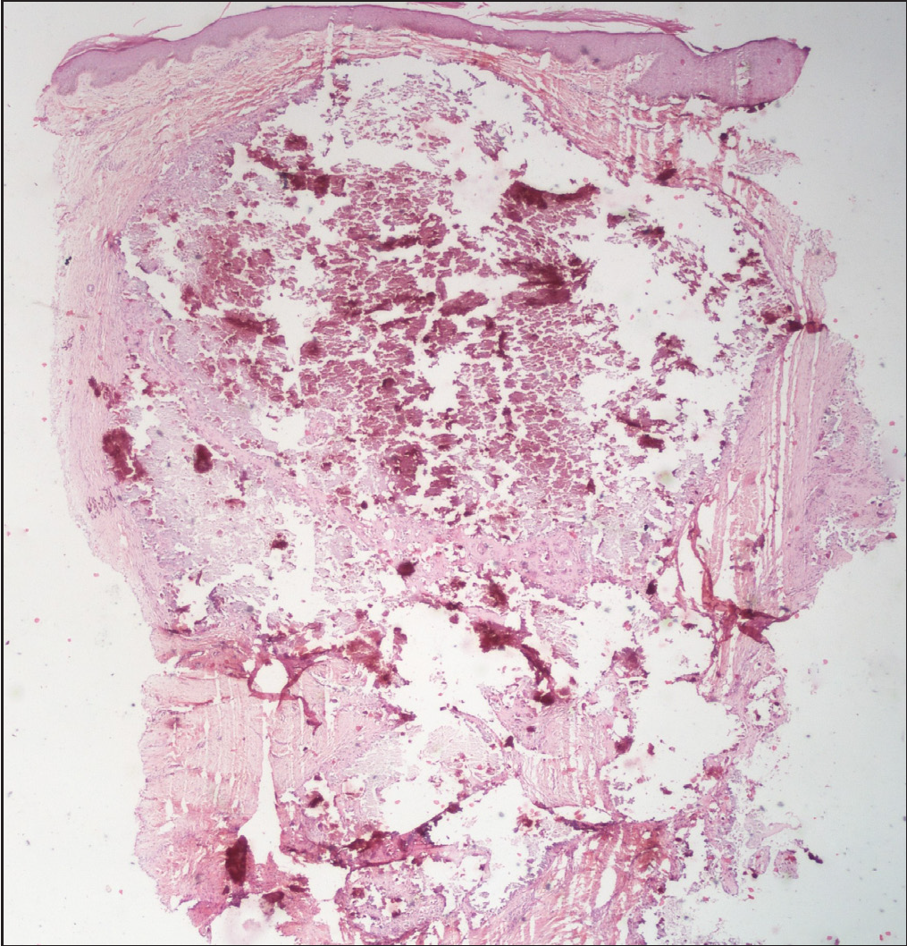 Biopsy from an erythematous papule showing a large central collection of amorphous purple deposits with a fragmented appearance, suggestive of calcium (haematoxylin and eosin, x20)