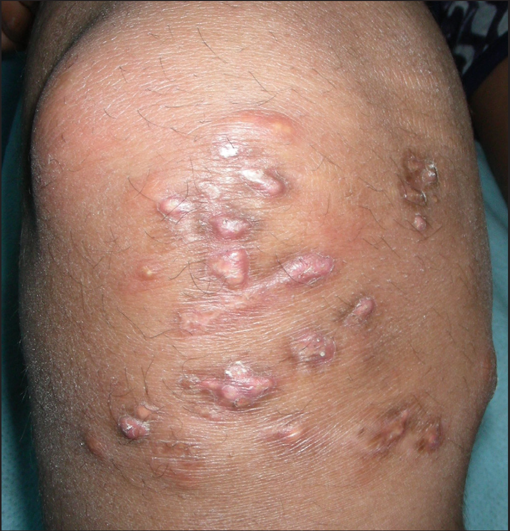 Response with sodium metabisulfite ointment in traumatic calcinosis cutis. Significant decrease in discharge, crusting and size of the papules. Complete resolution of a few papules with atrophic scars