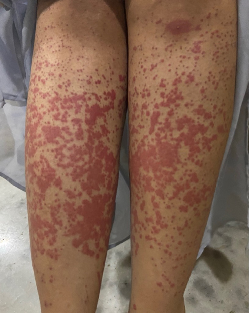 Palpable purpura over the lower extremities.