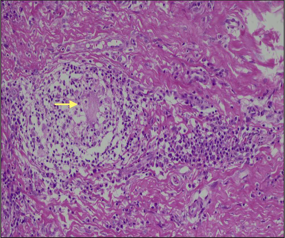 H&E at high power (200×) showing a non-necrotizing epithelioid cell granuloma with a Langhans type of giant cell in the centre (yellow arrow) and surrounding lymphocytic cuffing.