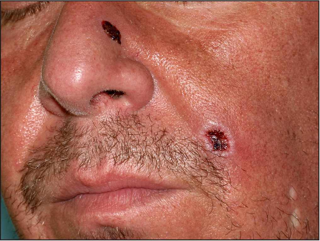 Ulcerative lesions on face