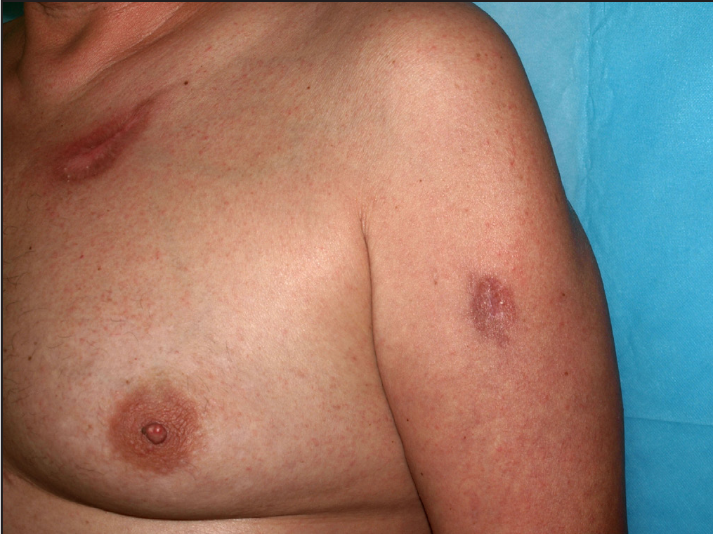 Almost complete disappearance of the lesions after treatment