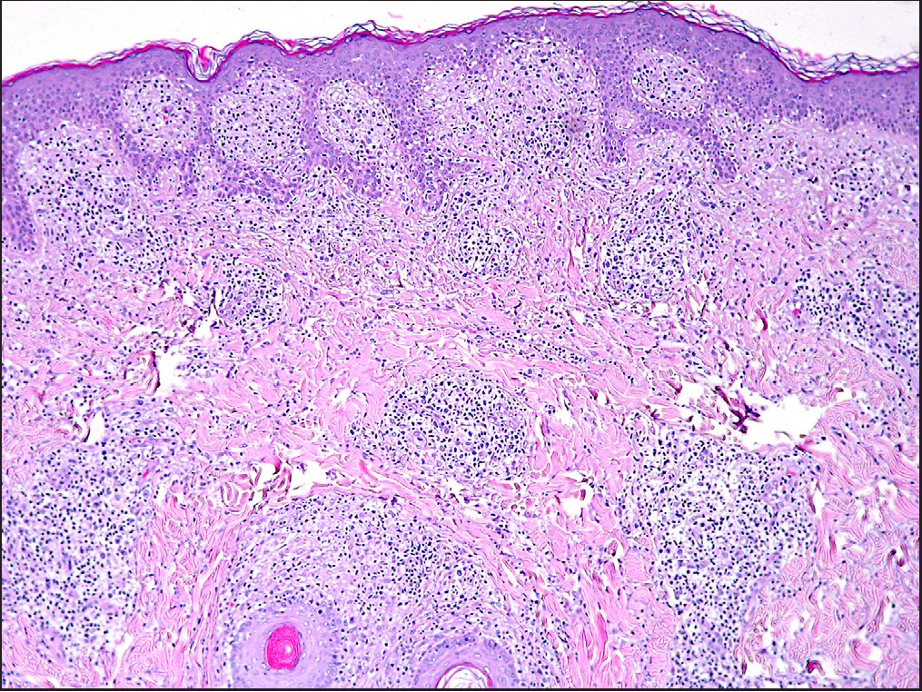 Irregular acanthosis of the epidermis with epidermal lining of small-sized halo-lymphocytes and folliculotropism; in the dermis: dense nested lymphocytic infiltrate (H and E, 100 X)