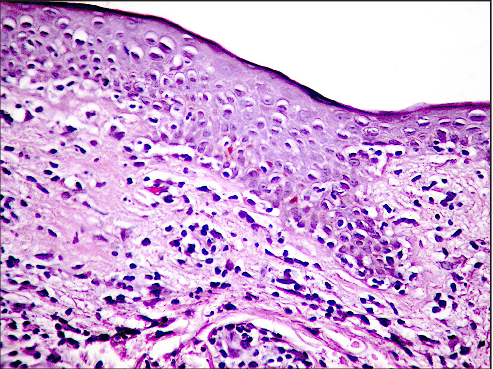 Epidermis: epidermotropism consisting of lining of small-sized lymphocytes along the basal epidermal layer, suggestive of epidermotropic lymphoma (H and E, 400 X)