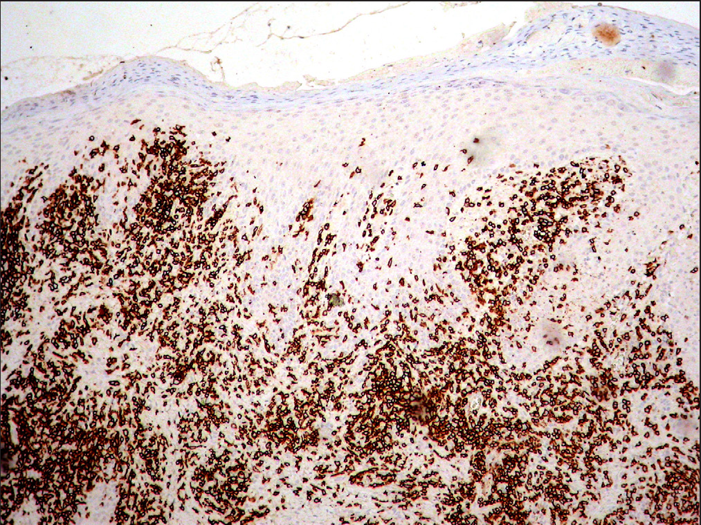 CD8 was positive in the epidermotropic lymphocytes and in around 80% of the dermal infiltrate