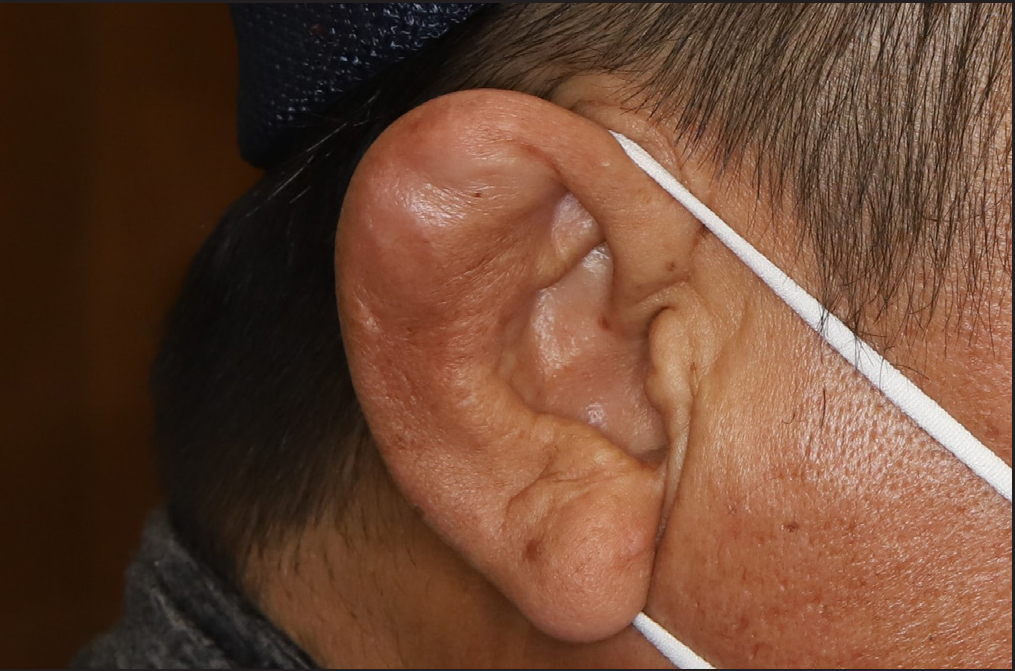 Pseudocyst Of The Auricle Treated With Intralesional Sodium Tetradecyl