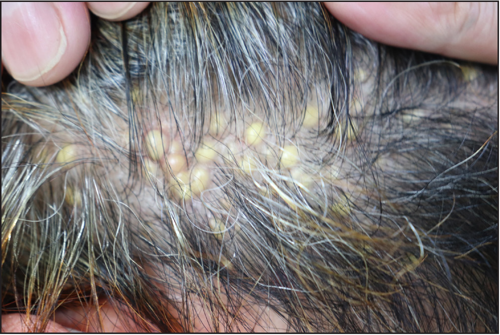 A patient with multiple asymptomatic yellow papules on the scalp ...