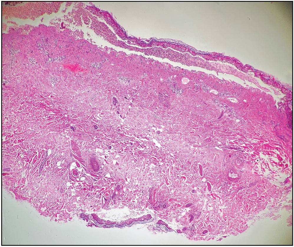 Dermo-epidermal clefting associated with intense basal vacuolar degeneration (H & E 100×)