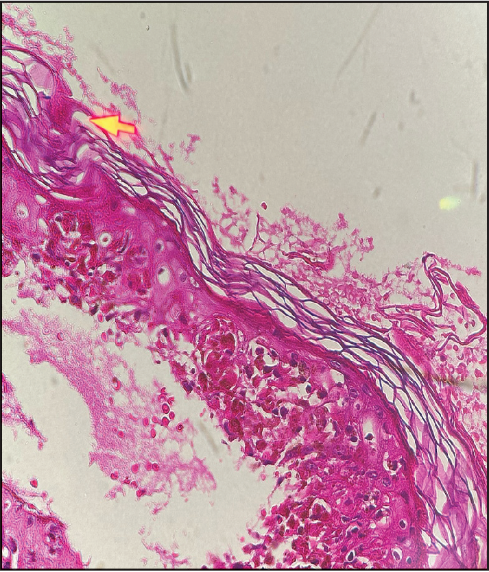 Basal cell vacoular degeneration with numerous necrotic keratinocytes and a perivascular lymphocytic mononuclear infiltrate with eosinophils (H & E 400×)