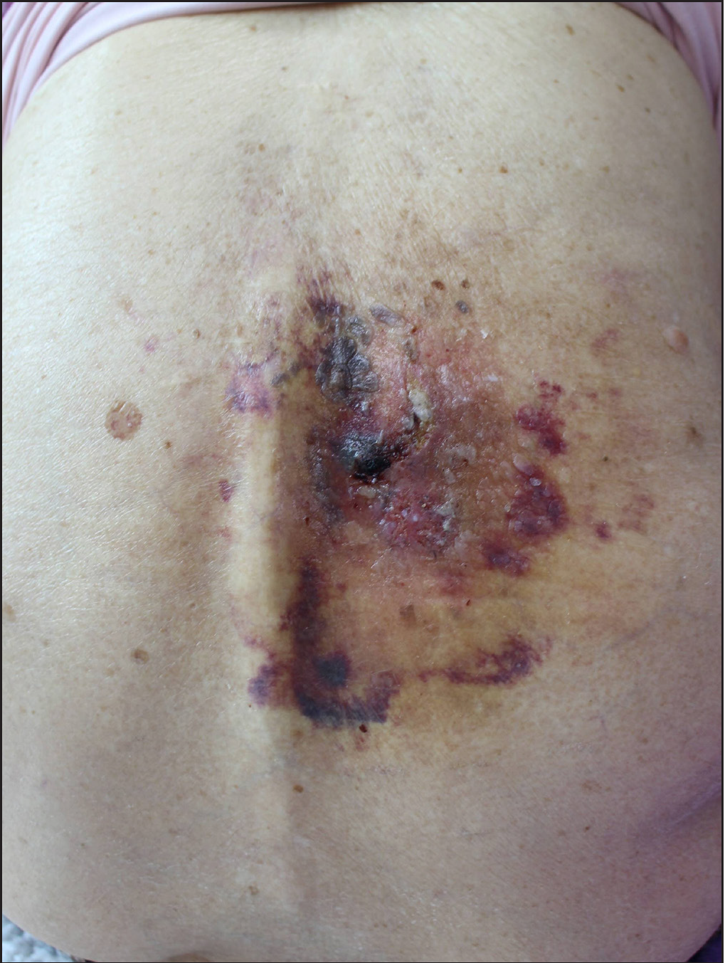 Focal erythematous to violaceous patches and plaques with some pigmentation and ulcerations on the patient’s right back