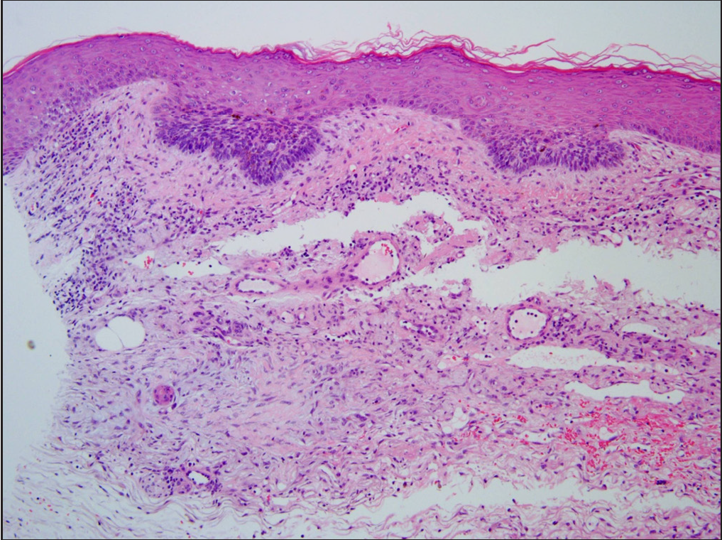 Several nests of basaloid cells arising from the basal layer are visible (H&E, ×100)