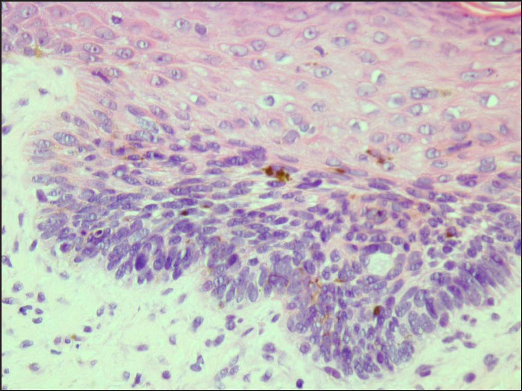 The basaloid cells are confined to the basal layer and do not extend beyond the papillary dermis (H&E, ×400)