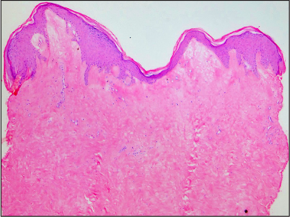 Irregularly acanthotic epidermis, prominent papillary dermal edema and marked upper dermal sclerosis (haematoxylin and eosin, x100)