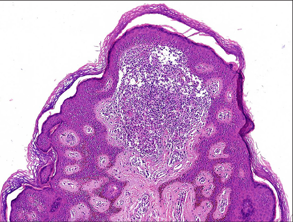 A dense, superficial lymphohistiocytic infiltrate bounded by elongated rete ridges (H&E, 100X).