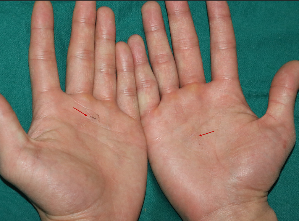 Umbilicated papules coalesced into patches on both palms (indicated by red arrow)