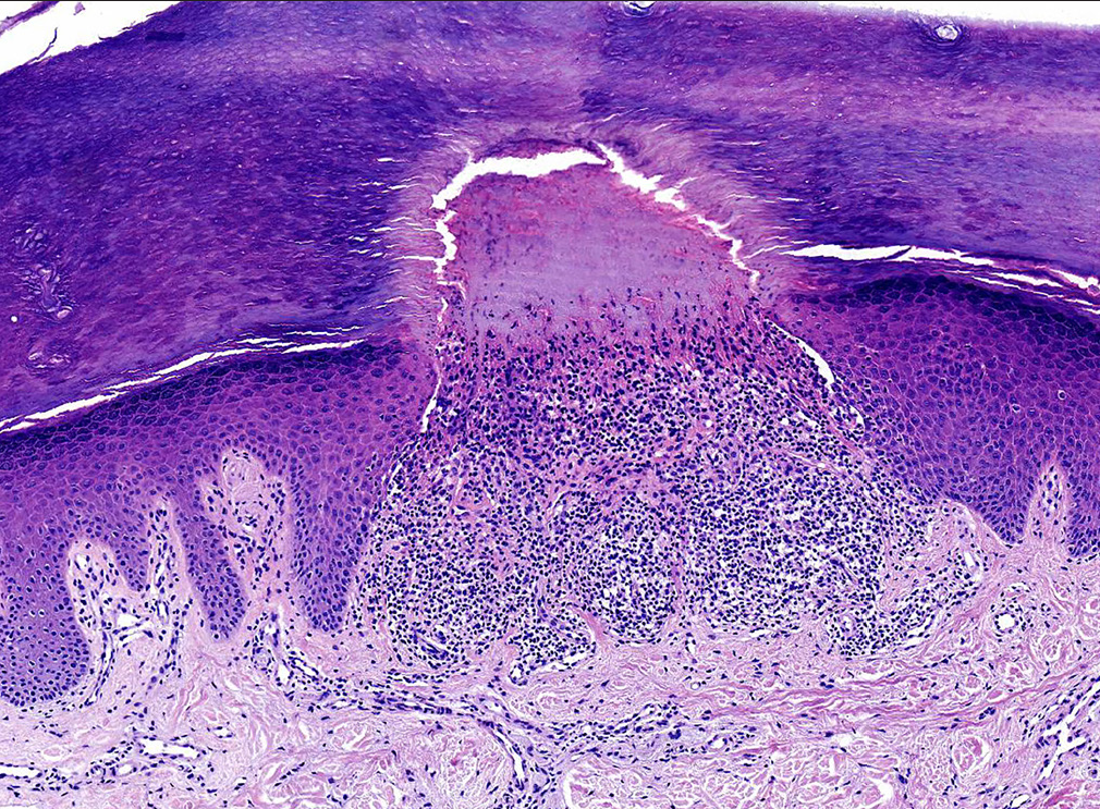 A dense lymphohistiocytic infiltrate covered by atrophic epidermis and bounded by elongated rete ridges in a broadened dermal papilla. Keratin and lymphohistiocytic cells extended to the surface via a transepithelial perforation channel (H&E, 100X)