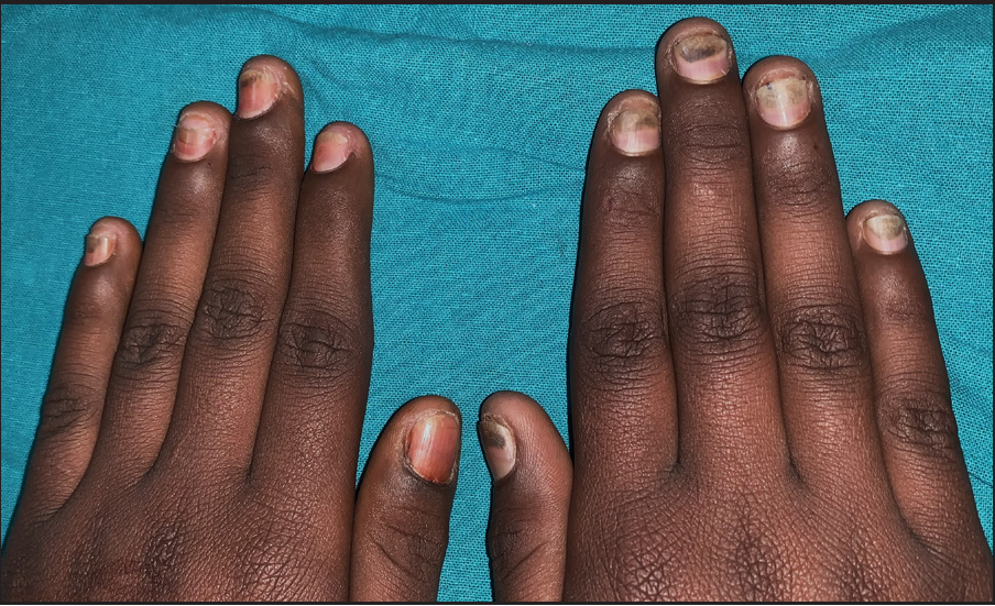 Approach to inherited hypertrichosis: A brief review - Indian Journal of  Dermatology, Venereology and Leprology