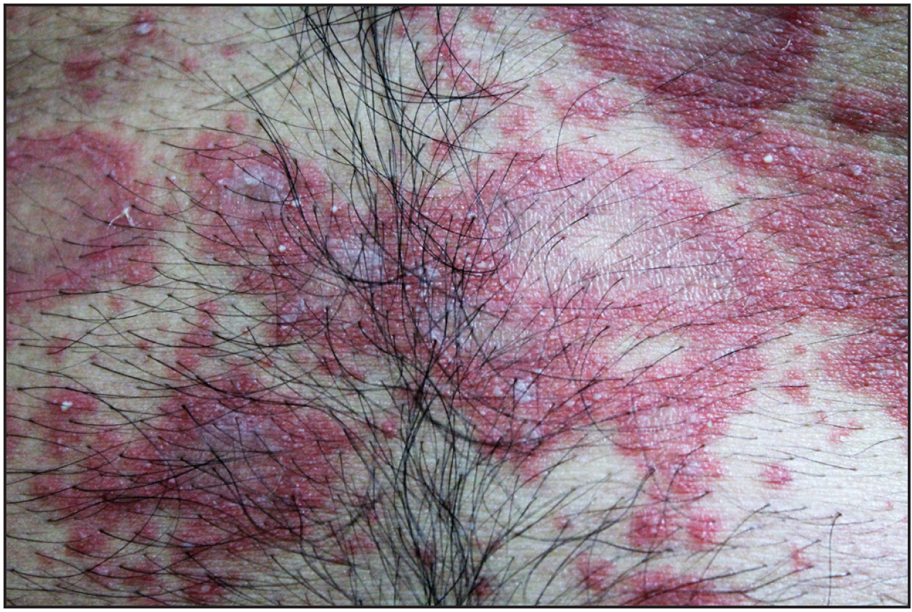 Pustular psoriasis: A distinct aetiopathogenic and clinical entity ...