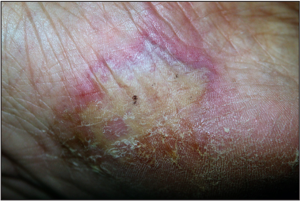 Pustular Psoriasis: A Distinct Aetiopathogenic And Clinical Entity 