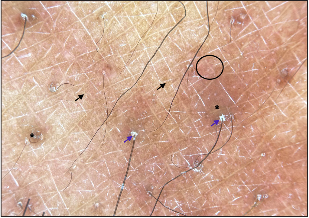 Dermatoscopic evaluation of erythema-ab-igne: Accentuated pigment network (black arrows), follicular hyperkeratosis (blue arrows), polymorphous vessels (black circle) over a diffuse brown background (black asterisk) (DermLite DL4, 10x polarised)