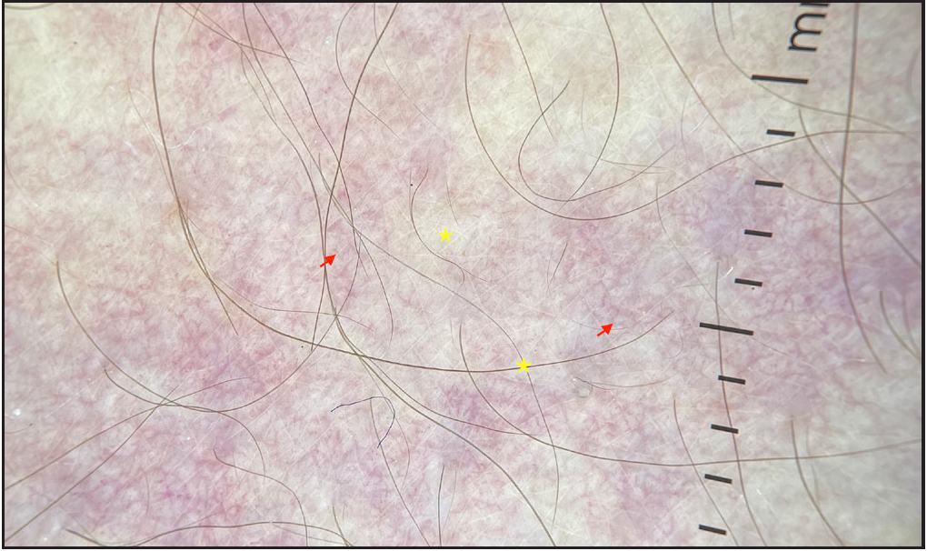 Dermatoscopic evaluation of erythema-ab-igne: Telangiectasias (red arrows) over a white background (yellow asterisk) in a patient with extensive erythema ab igne (DermLite DL4, 10x polarised)