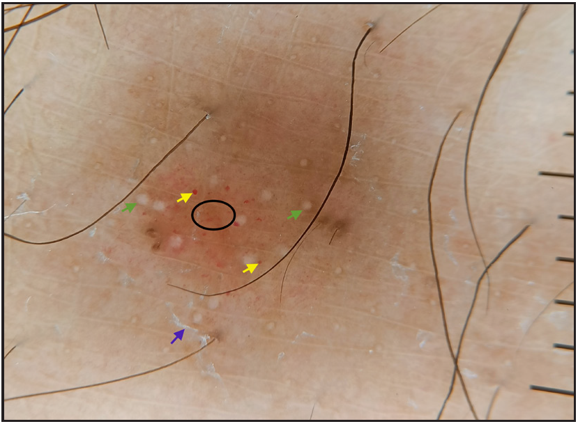 Dermatoscopic evaluation of erythema-ab-igne: Epidermal scaling (blue arrows), green arrows (dilated eccrine openings), red globules (yellow arrows), dotted vessels (black circle) (DermLite DL4, 10 ×, polarised)