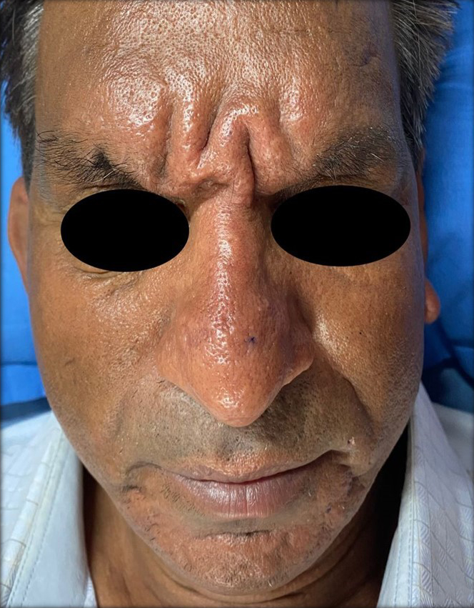 Doughnut Sign Scleromyxedema