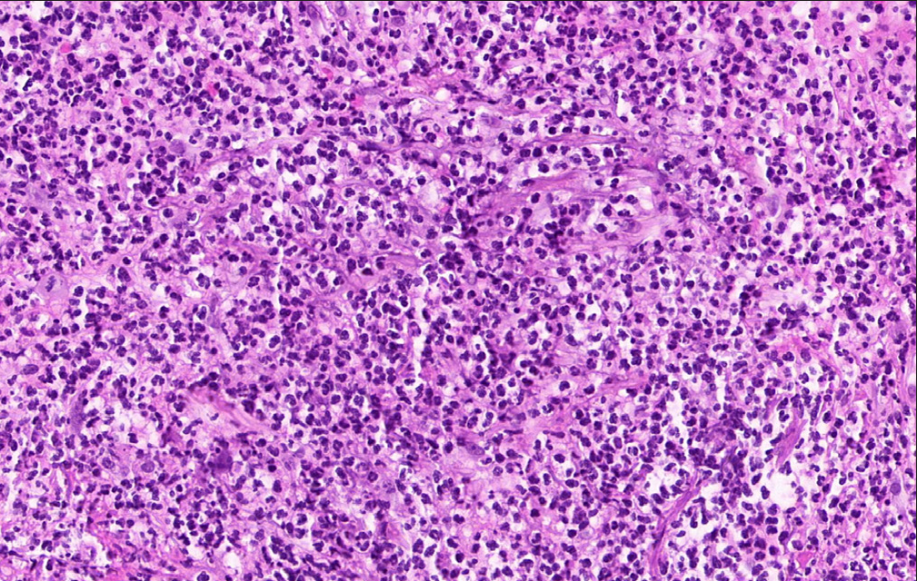 Heavy infiltration of neutrophils in the mid-dermis (H&E, ×200).