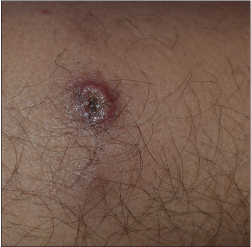 Umbilicated crusted plaque over the left leg