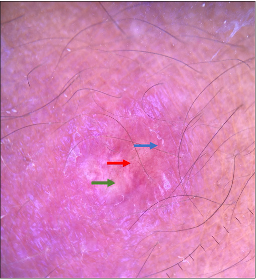 Dermoscopy of erythematous nodule showing irregular vessel (red arrow) on a yellow background (green arrow) with surrounding erythema and scaling (blue arrow) (Polarized mode, x10)