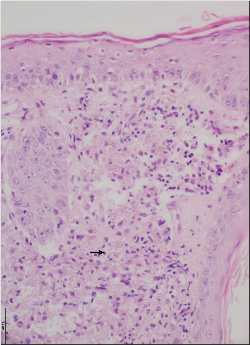 Skin biopsy shows the presence of numerous histiocytes with abundant foamy cytoplasm in the dermis (black arrow) (Hematoxylin and eosin, x200)