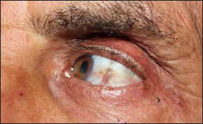 Yellow-brown discoloration in left conjunctiva