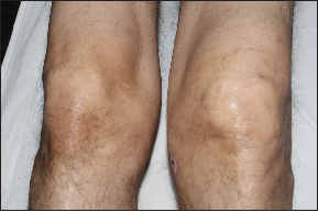 Swelling of the left knee joint