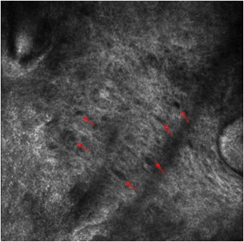 Oval dark spaces between irregular collagen fibers at lower magnification (red arrow)