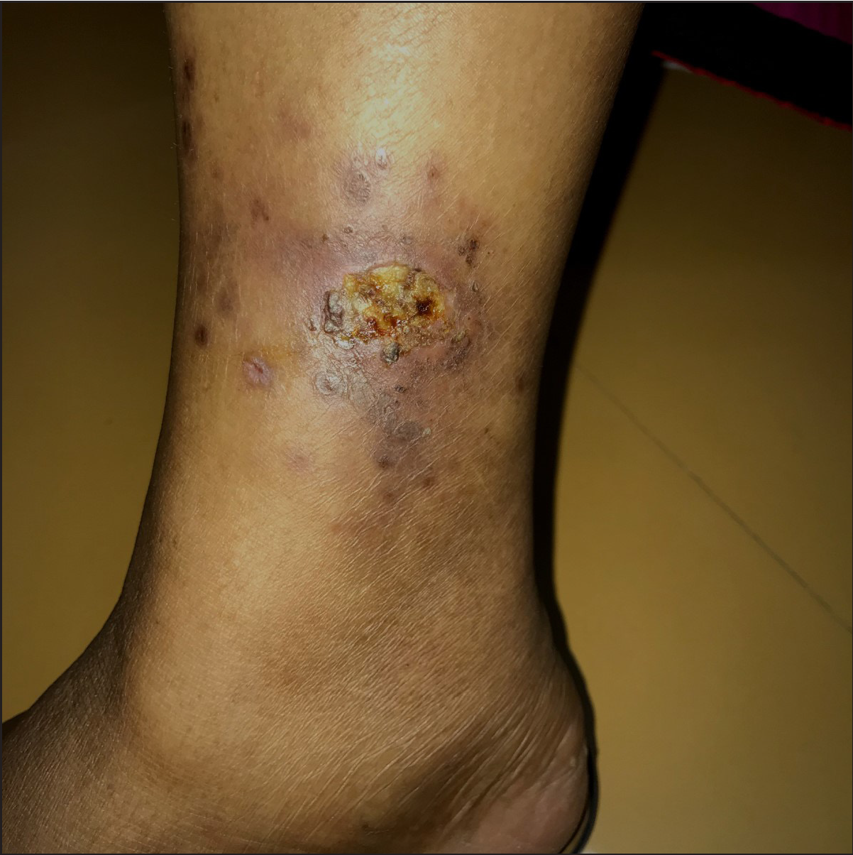 Clinicodermoscopic and immunopathological profile of non-infectious  non-eczematous inflammatory tattoo reactions: A retrospectiv