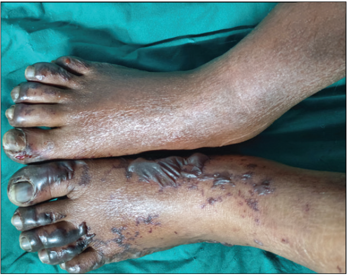 Multiple, widespread, necrotising, purpuric lesions and haemorrhagic bullae on both lower limbs.