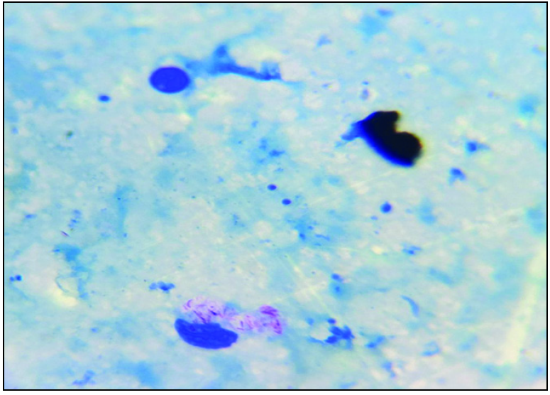 Slit skin smear shows plenty of uniformly stained acid-fast bacilli arranged singly and in globi. (H&E, 1000X)