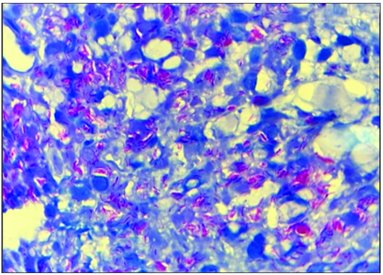 Fite-Faraco stain shows plenty of intracellular and extracellular leprae bacilli lying singly and in cigar bundles. (H&E, 1000X)