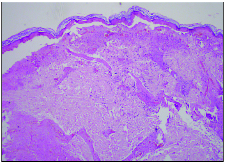 Histopathology shows epidermal thinning with artefactual separation at the dermo-epidermal junction. Dermis shows moderate to intense pan-dermal nodular perivascular infiltrate. (H&E, 40x)