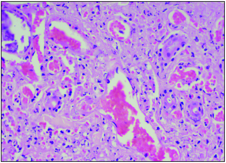 The section shows thrombosed vessels with predominantly lymphocytic infiltrate, necrotic debris and extravasation of RBCs with endothelial proliferation and focal destruction of the vessel wall. (H&E, 400×).