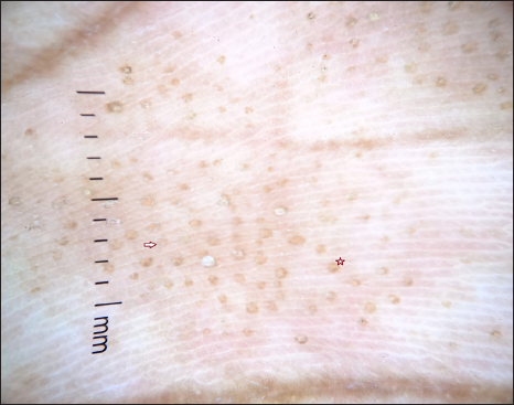 Dermoscopic image (10×) with polarising mode showing multiple well-circumscribed brownish-yellow depressed areas surrounded by a hyperpigmented rim (star) and a few lesions showing fine peripheral scaling (arrow mark).