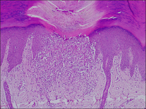 Showing focal parakeratosis with underlying thin epidermis and expanded papillary dermis with lymphohistiocytic infiltrate (H&E, 100×).